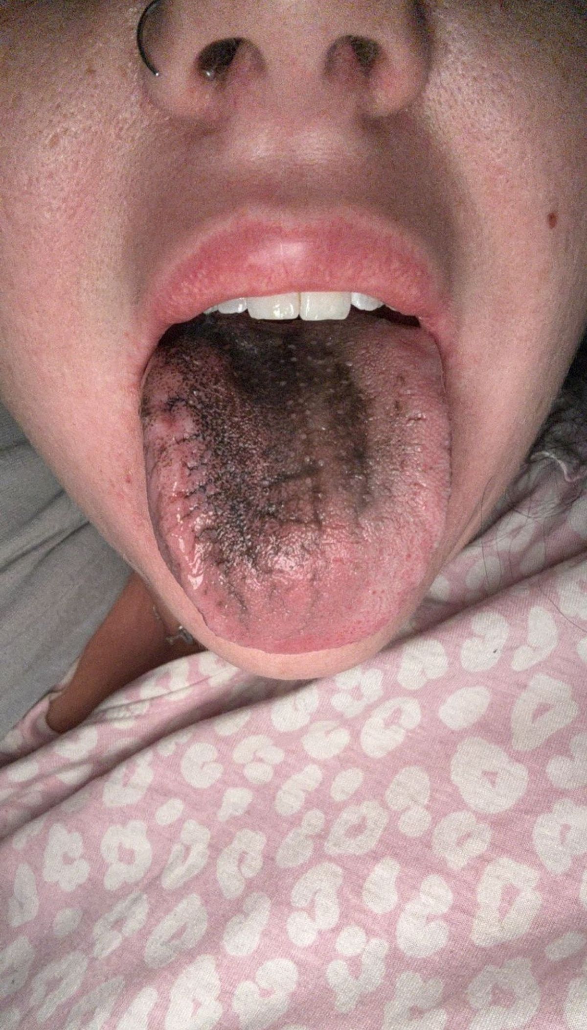 Sarah Jayne Crawford's black tongue after taking Wegovy